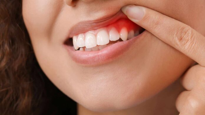 How to Cure Gum Disease Without a Dentist?